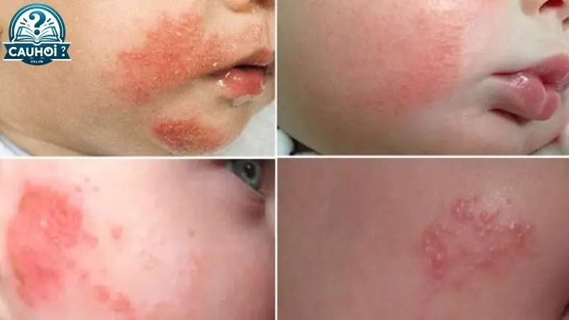 Bị kiến ba khoang đốt có nguy hiểm không? Bị kiến ba khoang đốt có nguy hiểm không?
