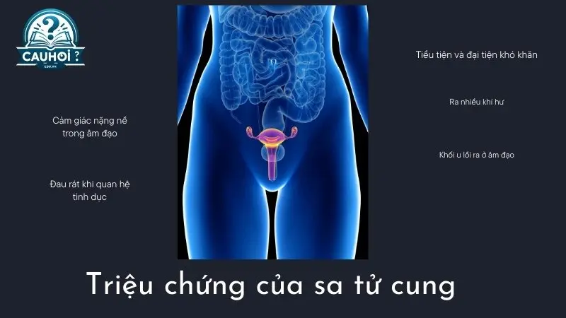 Triệu chứng của sa tử cung Triệu chứng của sa tử cung