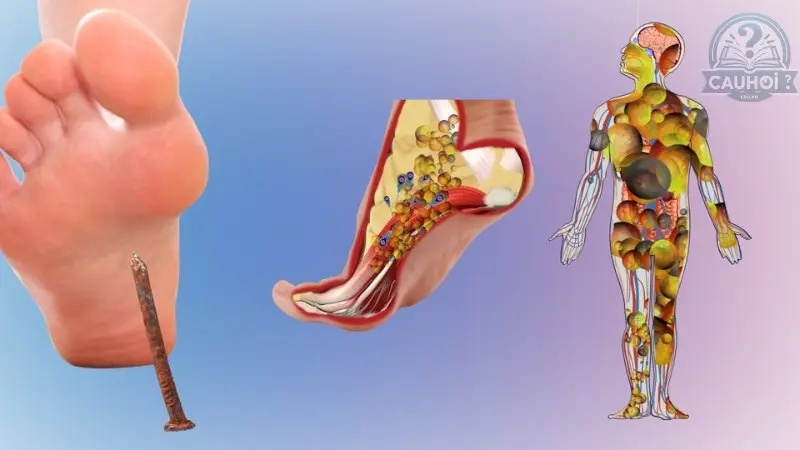 Giải thích chi tiết về bệnh uốn ván Giải thích chi tiết về bệnh uốn ván