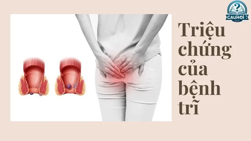 Triệu chứng của bệnh trĩ Triệu chứng của bệnh trĩ
