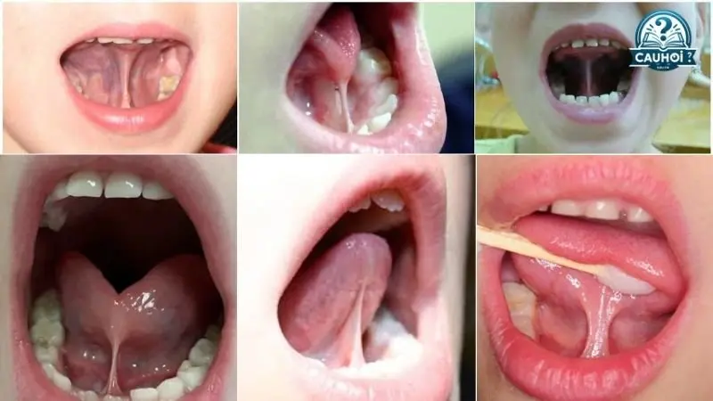 Dính thắng lưỡi là gì? Dính thắng lưỡi là gì?