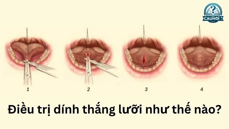 Điều trị dính thắng lưỡi Điều trị dính thắng lưỡi