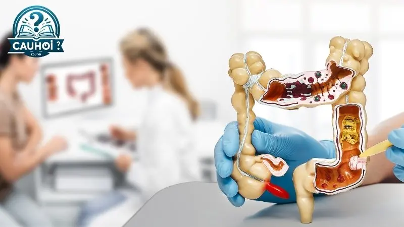 Tại sao phải nội soi đại tràng? Tại sao phải nội soi đại tràng?