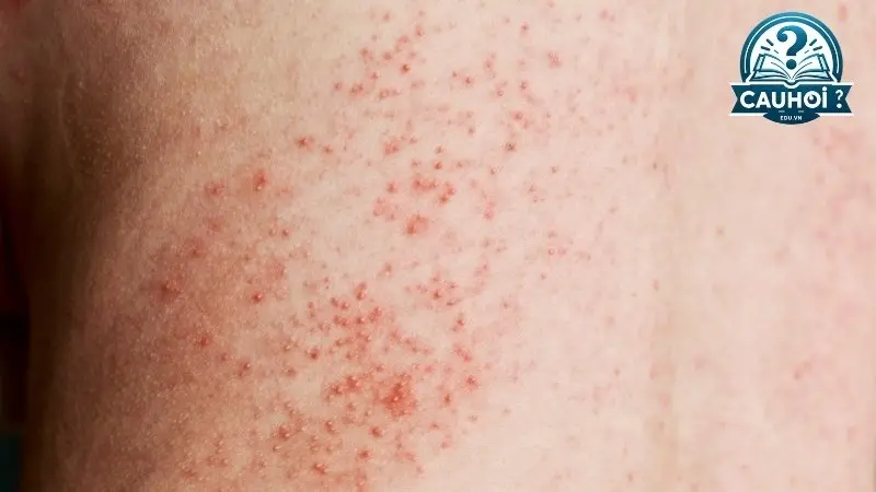 Đặc điểm nhận dạng của phát ban HIV Đặc điểm nhận dạng của phát ban HIV