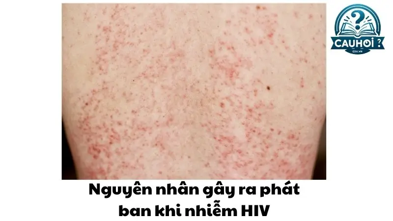 Nguyên nhân gây ra phát ban khi nhiễm HIV Nguyên nhân gây ra phát ban khi nhiễm HIV