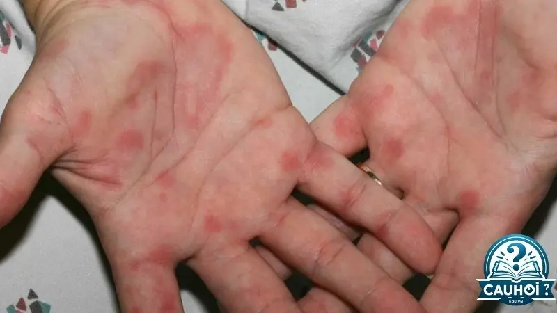 Phân biệt phát ban HIV với các loại phát ban khác Phân biệt phát ban HIV với các loại phát ban khác
