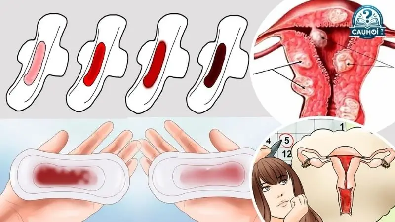 Nguyên nhân gây rong kinh Nguyên nhân gây rong kinh