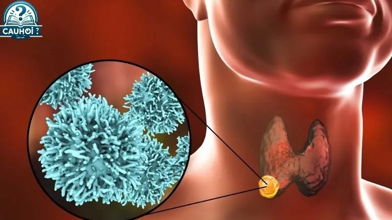 Định nghĩa và đặc điểm của u ác tính Định nghĩa và đặc điểm của u ác tính
