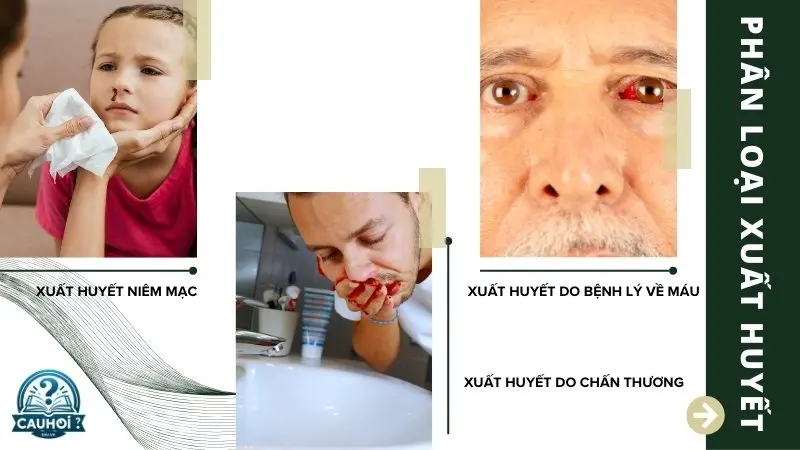 Phân loại xuất huyết Phân loại xuất huyết